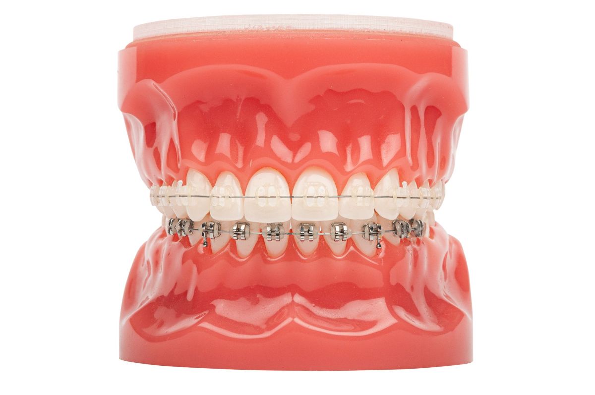 What Are The Different Types Of Braces Available?